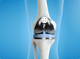 Knee Replacement Surgeon
