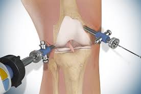 Knee Replacement Surgeon