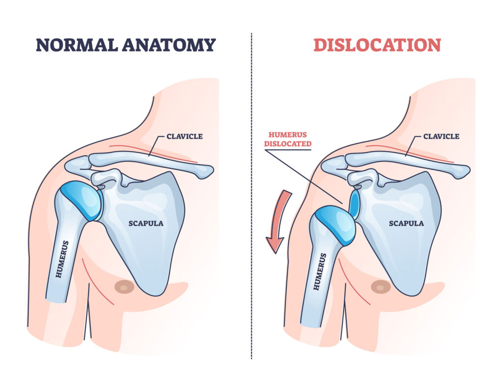 Shoulder dislocation