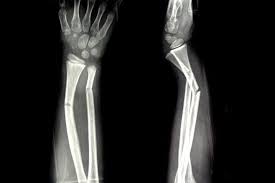 Fracture Surgeon