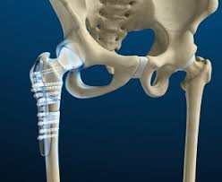 Hip Fracture Surgeon