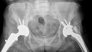 Hip Replacement Surgeon