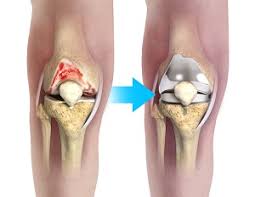 knee surgeon Bhopal